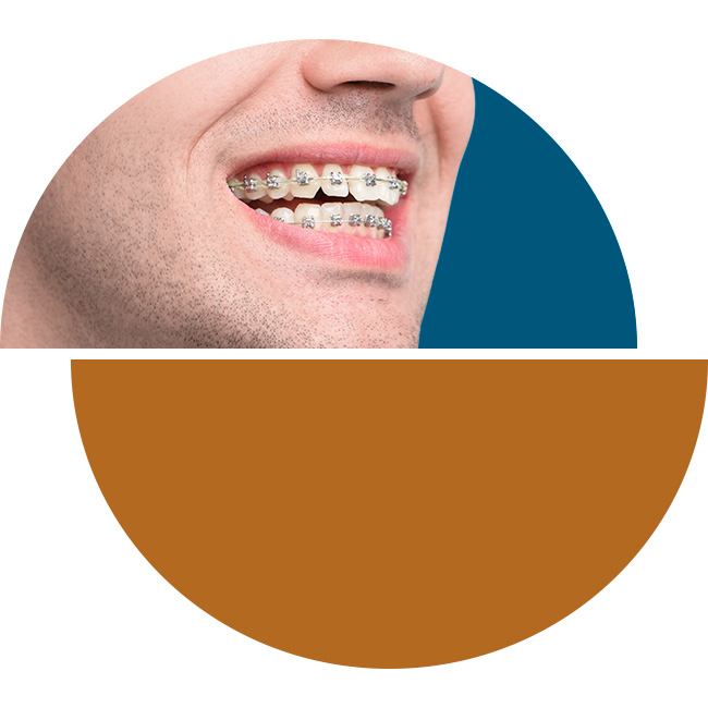 Ortodoncia brackets